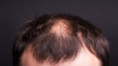 هل تغير المناخ يضر الشعر؟