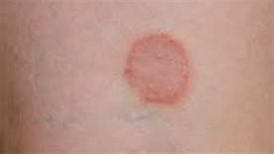 كيفية تجنب الإصابة بالتهاب الجلد الحفاضي