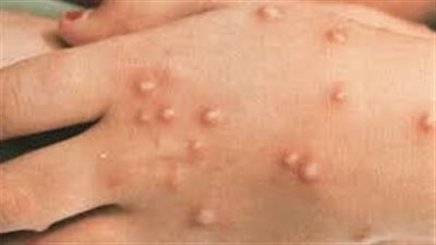 آخر تطورات فيروس مرض جدري القردة في أمريكا