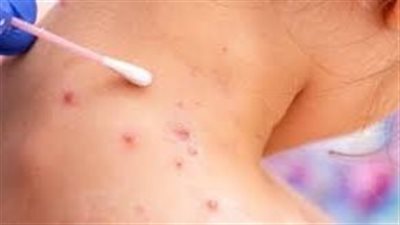 الصحة العالمية: رصد 18 ألف إصابة بمرض جدري القردة في 78 دولة