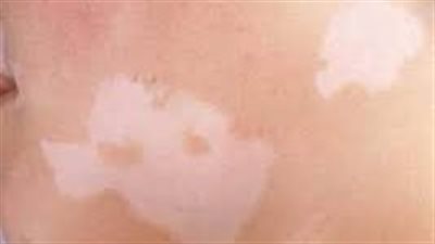 تفاصيل أول علاج موضعي للبهاق