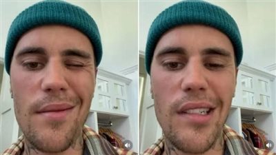  رغم إصابته بمتلازمة 