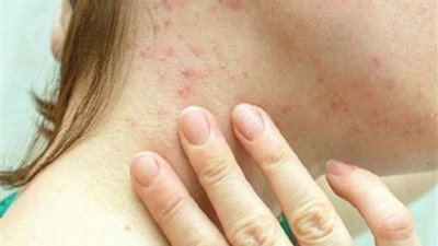 البرازيل: تسجل أول وفاة بجدري القرود