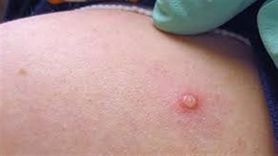  الولايات المتحدة: مرض جدري القرود حالة طوارئ صحية عامة (الأسباب)