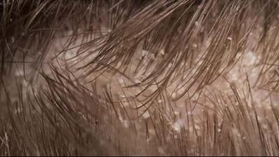 كيفية محاربة قشرة الرأس الجافة