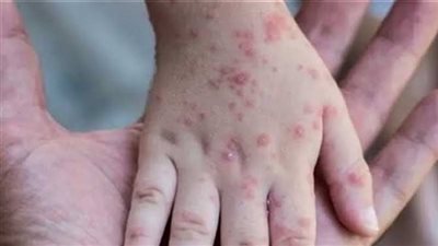 بيرو: إصابات جدري القردة تتخطى حاجز الـ500