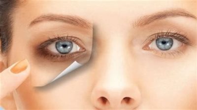  الهالات السوداء.. قد تشير إلى مشاكل الكلى أو الغدة الدرقية أو أحد أنواع الحساسية