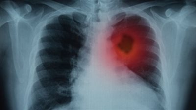 أعراض تشير إلى مرض سرطان الرئة
