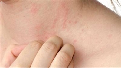 كيفية تخفيف متاعب الحساسية التلامسية