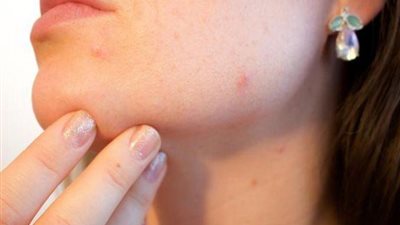 بلجيكا تسجل أول إصابة بجدري القردة