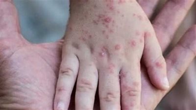 اليونان: رصد 48 حالة إصابة بجدري القرود