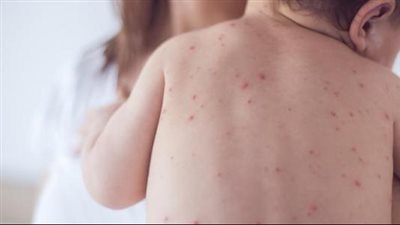 السلطات في زيمبابوي تكشف عن وفاة 157 طفلًا على الأقلّ بالحصبة