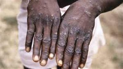  علماء الفيروسات الفرنسيون يكشفون يتحدثون عن جدري القردة