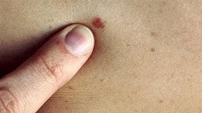 أطباء عن درجات الحرارة المرتفعة الصيف: قد تؤدي إلى زيادة في الأورام