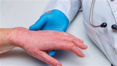 ارتفاع إصابات جدري القردة بنسبة 20% خلال أسبوع