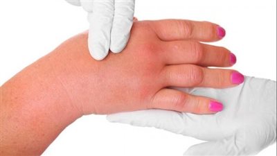 أعراض الماء الزائد في الجسم.. 10 أسباب تحفز ظهورها