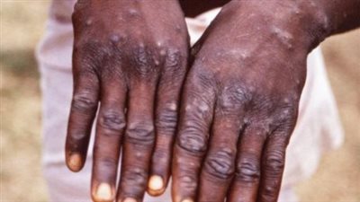 رصد متحور جديد من فيروس جدري القرود في بريطانيا