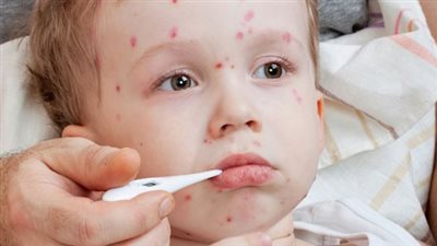 وزارة الصحة في لوكسمبورج تعلن إصابة بجدري القرود لطفل رضيع