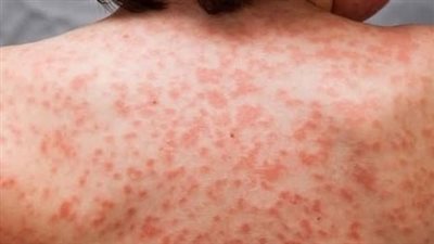 حالة من الهلع بعد ظهور مرض غريب بولاية الجلفة الجزائرية