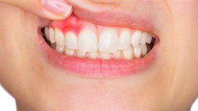 أخصائي روسي يكشف أسباب التهاب اللثة