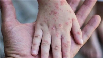 نيويورك: رصد أول حالة إصابة بجدرى القرود