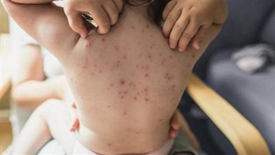  وزارة الصحة الإندونيسية تعلن عن رصدها أول إصابة بمرض جدري القرود 