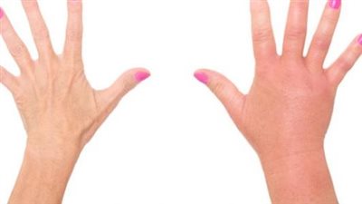 أضرار زيادة الماء في الجسم.. إليكم معدلات النسب الطبيعية للسوائل 