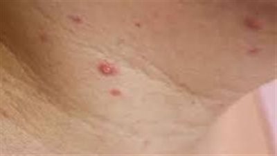  تسجيل أول حالة من مرض جدري القردة في كوبا