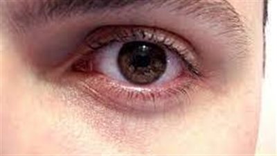 الكشف أحد أبرز أسباب الإصابة بالعمى