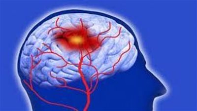  تقنية جديدة تتيح اكتشاف احتمال الإصابة بالسكتات الدماغية