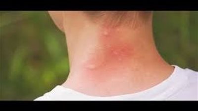 أخصائية أمراض جلدية تكشف عوامل تعمل على نخفف التورم