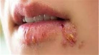 باحثون يكشفون تاريخ السلالة الحديثة من فيروس هربس الوجه