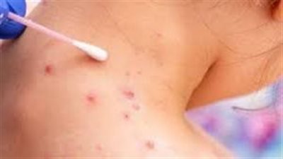  تسجيل إصابات بجدري القردة في جميع أنحاء الولايات الأمريكية