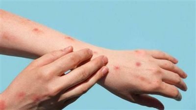 اليابان تحذر رعاياها في 7 دول أفريقية من خطر جدرى القرود