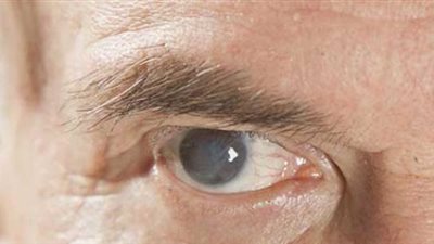  دراسة جديدة تتحدث حول التجارب الأولى لإذابة البروتين المتراكم داخل عدسة العين