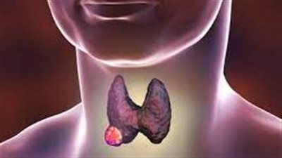 طبيبة روسية تكشف عن علامات أولية تشير إلى سرطان الغدة الدرقية