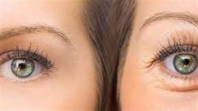 خبراء: التغذية غير الصحية تظهر على الوجه