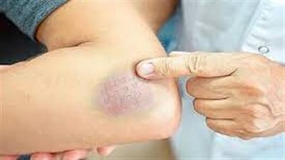 طبيب روسي يوضح الفروق بين الكدمات التي تظهر على الجلد