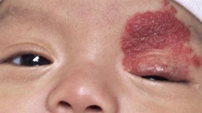 الوحمة الدموية على جفن العين