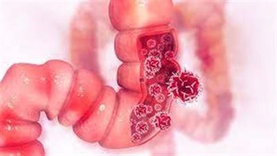 عوامل تساعد في انتشار سرطان الأمعاء