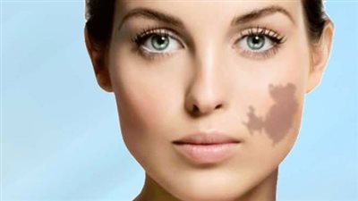 الوحمة الدموية عند الكبار