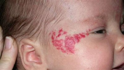 خطورة الوحمة الدموية