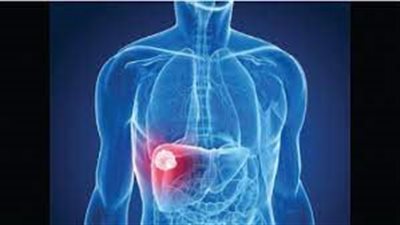 طريقة جديدة لتشخيص مرض الكبد الدهني غير الكحولي