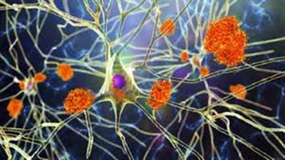 دراسة: مرض ألزهايمر يختبئ سنوات طويلة قبل أن يظهر أعراضه الأولى