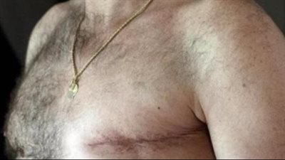 كل ما تريد معرفته حول سرطان الثدي للرجال