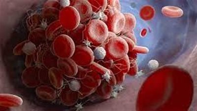 عوامل تؤدي إلي زيادة خطر الجلطات الدموية الوريدية