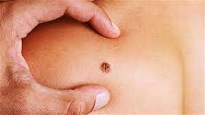 يتسبب في سرطان الجلد.. إليك التأثير السلبي للمضادات الحيوية