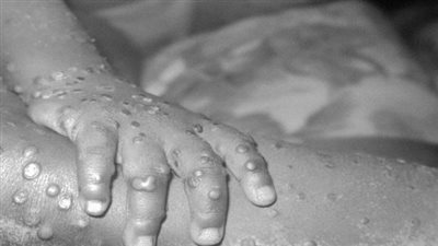 الصحة العالمية تحذر من تفشي جدري القردة بشرق الكونغو 