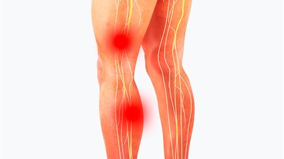 عرق النسا الكاذب.. ما هو؟