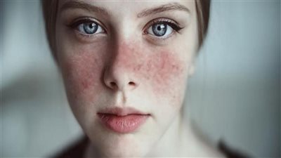 طريقة مبتكرة لعلاج من يعانون من مرض الذئبة